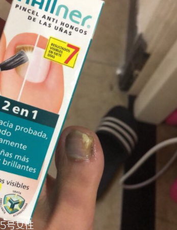 灰指甲治疗心得,个人治疗灰指甲的经验