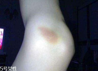 黑眼圈像淤青怎么形成的,淤青怎么形成的