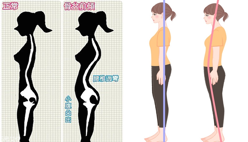 如何判断自己是否为骨盆前倾,怎么判断自己是骨盆前倾 如何判断自己是否为骨盆前倾,怎么判断自己是骨盆前倾