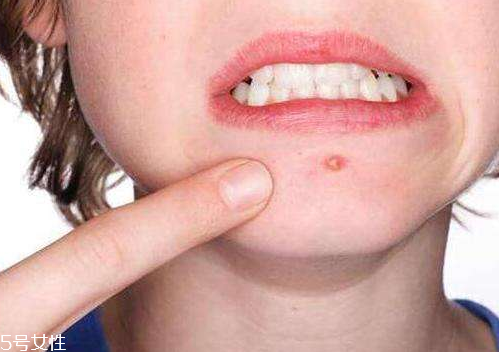 如何一天之内消除痘痘,痘痘怎么一天消除 如何一天之内消除痘痘,痘痘怎么一天消除