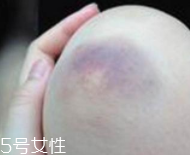 轻轻一碰就有淤青是怎么回事,身体稍微碰一下就淤青