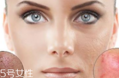 痘印怎么形成原因,为什么会有痘印 痘印怎么形成原因,为什么会有痘印