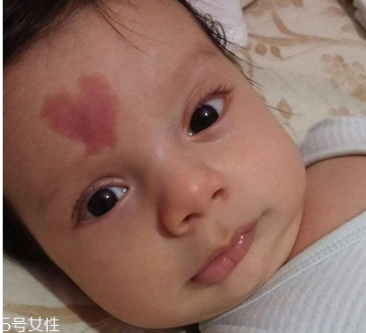 去胎记后怎么护理,胎记去除过程 去胎记后怎么护理,胎记去除过程