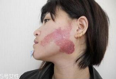 胎记会遗传吗?,胎记会遗传给下一代吗