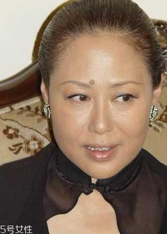 抠掉的痣又长出来会癌变吗,抠痣会癌变吗