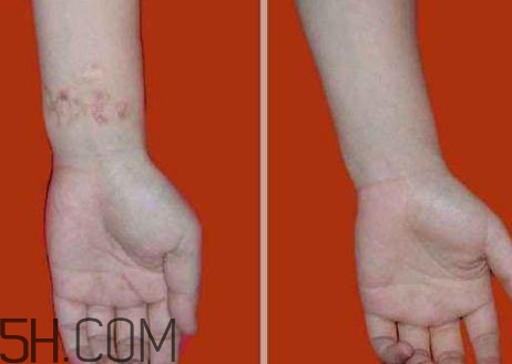 密丽除疤膏效果对比照,密丽除疤膏效果如何