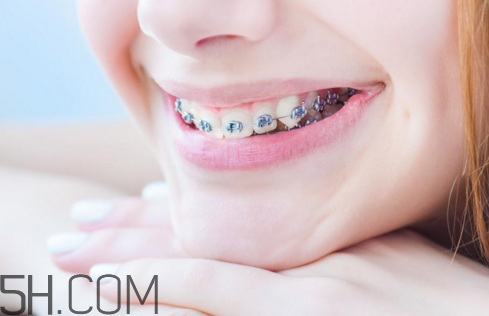 戴牙套需要注意什么,佩戴牙套的注意事项
