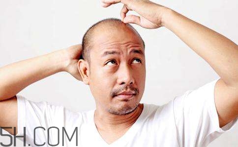 为什么男人脱发比女人严重,为什么男性比女性更容易脱发