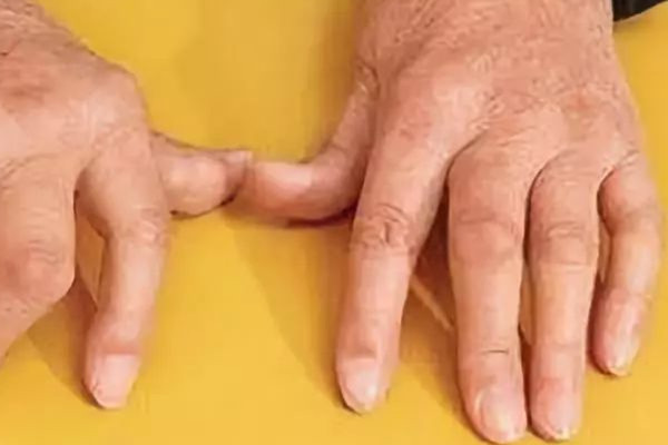 湿气的分类有哪些(湿气有几种类型)