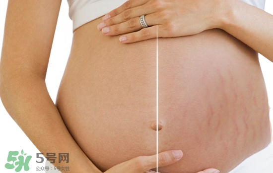 怎么看妊娠线知男女(根据妊娠线怎么看男女) 怎么看妊娠线知男女(根据妊娠线怎么看男女)