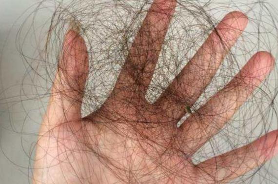 产后严重脱发(产后严重脱发怎么办)